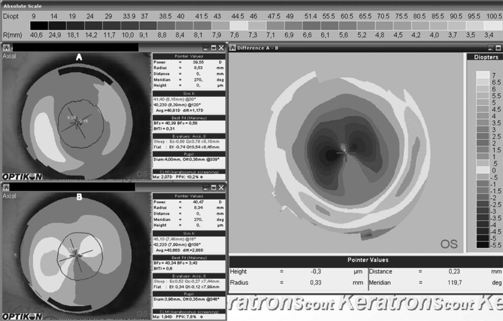 Eye & Contact Lens Volume 38, Number 4, July 2012 Orthokeratology for Astigmatism FIG. 2. Corneal topography view showing the typical centered posttreatment bulls-eye profile (axial subtractive map) on a toric cornea (corneal astigmatism 22.