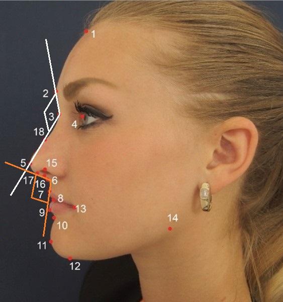 Evaluation of rhinoplasty effect on facial attractiveness predictor estimate t-value p-value intercept after-before 3.832 1.696 0.043 nasofrontal angle after-before 0.353 1.969 0.