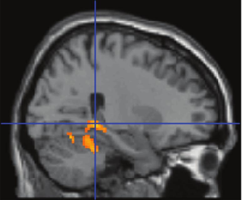 Group-averaged statistical parametric maps are rendered onto the MNI brain template (P-corr. < 0.05).
