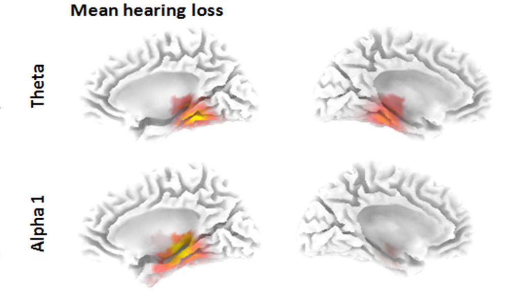 loss The more hearing loss