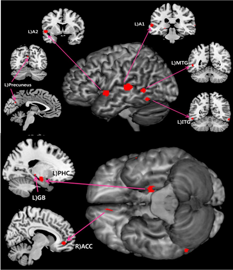 Subgenual anterior cingulate cortex Vanneste & De Ridder, Frontiers in