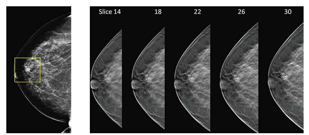 1. Consistent color modalities 2. 2D vs 3D mammography Combining mammograms with color modalities such as breast ultrasound and MR has proven to improve breast cancer detection rate.