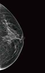 Cassette type Images s exceptional image quality has gained a reputation amongst breast cancer physicians as being comparable to