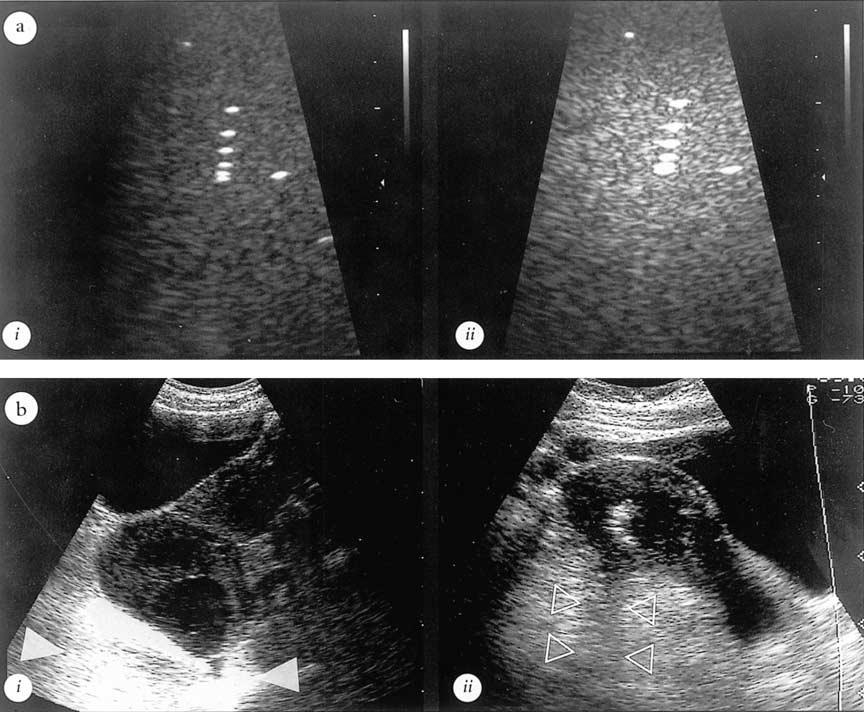 6 Practical Gynaecological Ultrasound Figure 1.6 Inappropriate time gain compensation (TGC) settings can cause misleading impressions. (a)(i) Correct TGC with good resolution of all the wires.