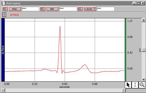 o The value of the Threshold Level in the Peak Detector box determines how the software will read each R-wave.