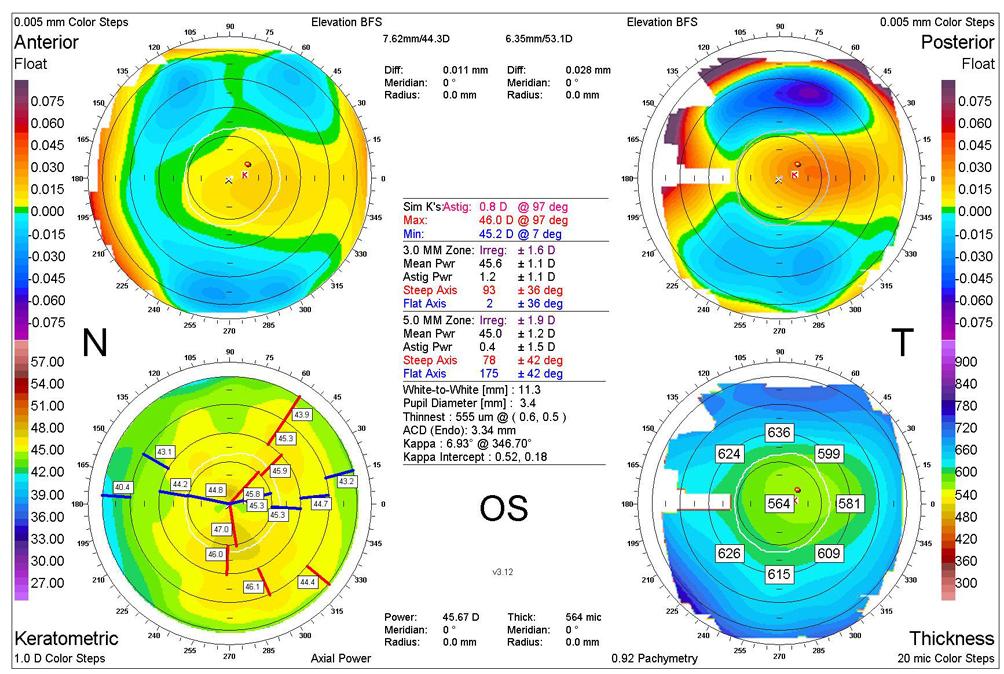 A WTR astigmatism was defined when a patient s Sim K was between 45 and 135 degrees in topography.