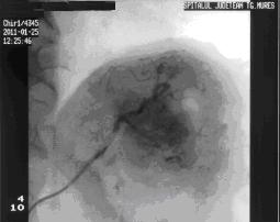 Evidenţierea arteriografică a arterei gastrice stângi, ale cărei ramuri vascularizează tumora Figura 2.