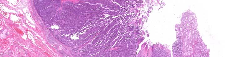 MANAGEMENT CLINIC Figura 5. Perete gastric cu mucoasă gastrică iar subiacent cu formaţiunea tumorală (carcinom neuroendocrin) Figura 6.