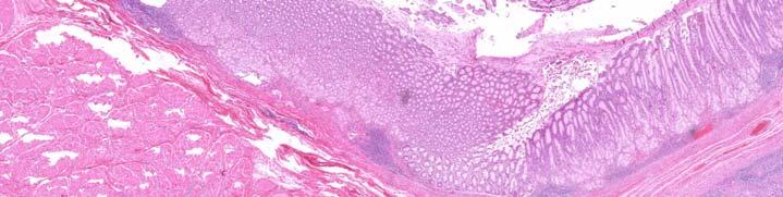 Sindromul carcinoid apare de obicei tardiv în evoluţia bolii, în prezenţa metastazelor hepatice, ca urmare a hipersecreţiei hormonale şi este clasic descris ca asocierea de flush şi diaree, mai rar