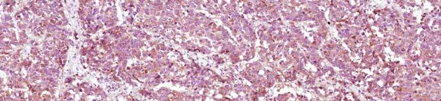 Figura 7. Celulele tumorale prezintă pozitivitate citoplasmatică la imunomarcajul cu Synaptophisin Figura 8.