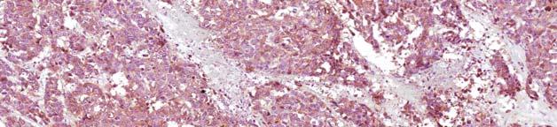 Celule tumorale prezentând pozitivitate nucleară la imunomarcajul cu Ki67 (rată de proliferare marcată) multiple, recurente, cu