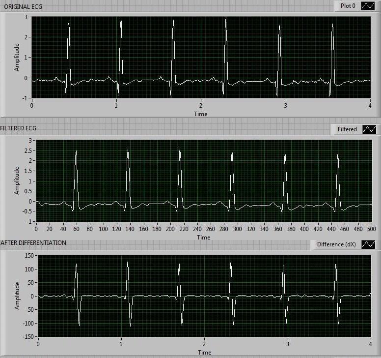 Input/Output waveform of Normal Sinus Rhythm Inputs