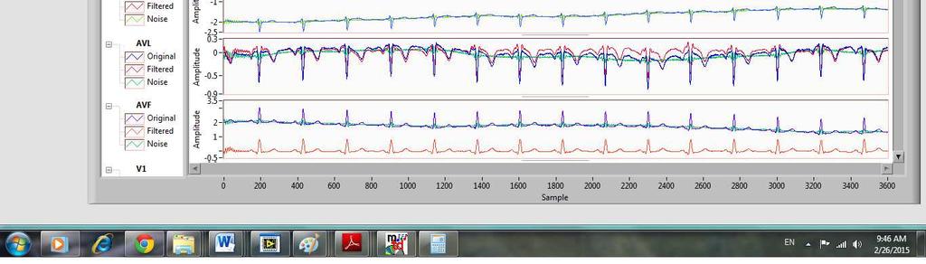 The experimental result of ECG database record number 117 from MIT-BIH. Figure 8.