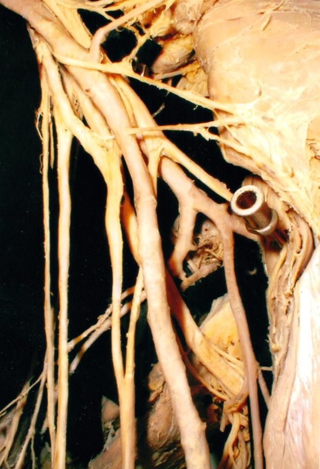 0 7 Fig..Bifurcarea arterei majistrale a membrului. A.axillaris. superior (a. axillaris) la nivelul. ansei duble a nervului median - a.axillaris; - a. brachialis (a. brachialis superficialis); - a.