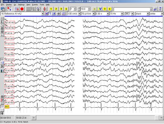 PL-Winsor PL-Winsor, Walter Graphtek's EEG recording and review software, is suitable for routine EEG, PSG/sleep studies, longterm EEG, ambulatory EEG and