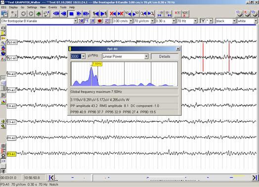 interest by clicking to the EEG scroll bar which denotes the markers set during acquisition.