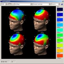 Amplitude-integrated EEG In addition to the EEG signals, the aeeg option displays EEG data like a Cerebral Function Monitor (CFM)