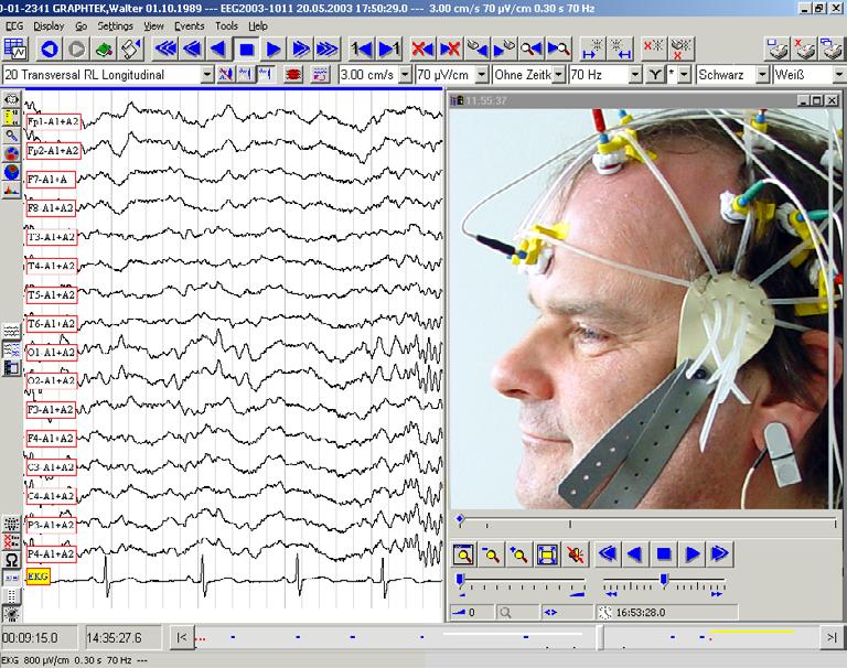 Videometry With the PL-VIDEO-D4 videometry option installed, your PL-EEG becomes a powerful and flexible unit for epilepsy monitoring, sleep