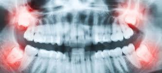 DAY 2 ARTICLE Self-repairing Tooth No drills, needles, or PAIN! Scientists at King s College in London have found a way for a decayed tooth to fix itself.