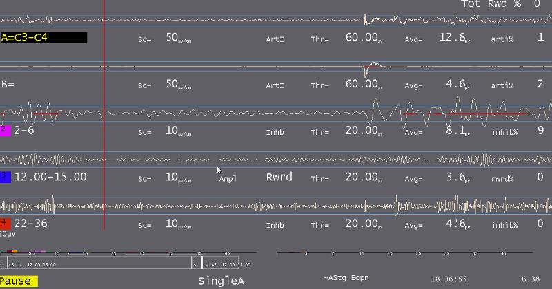 Figure 17: Waveform Display Here s the EEG screen with a full single channel EEG displayed. Notice the red line that sweeps across the screen.