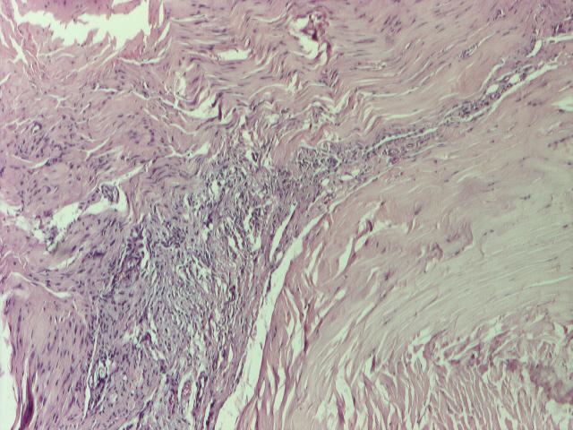(vimentina, actina muschi neted), a markerilor de endoteliu vascular (CD34) si de proliferare (Ki-67).