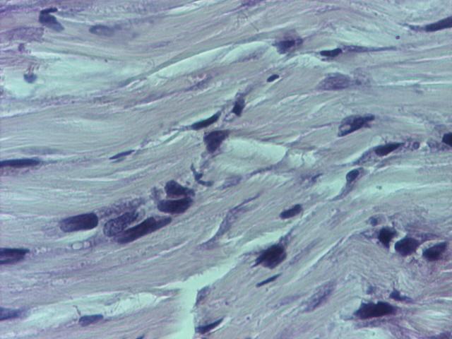 si paratenonului sunt prezente vase sanguine mici hiperemiate (Fig.