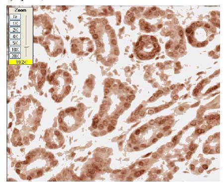 Colocalization separates the two stains and the cytoplasmic component is identified as the area where DAB only is present, without Hematoxylin staining.