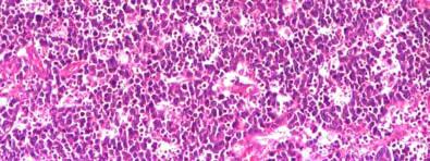 Histopatologic, s-au constatat fragmente de perete de intestin subţire (ileon), cu infiltrare tumorală masivă şi difuză, cu celule limfoide de talie medie şi numeroase macrofage cu corpi apoptotici,