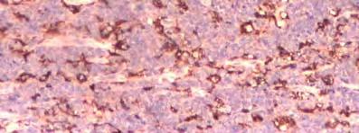 Hiperplazia limfoidă nodulară a intestinului este frecvent întâlnită în etiopatogenia limfomului malign.