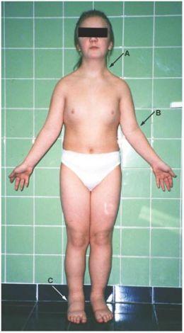 Adolescentele Inălţime mică : pacientele cu sindrom Turner au o înalţime cuprinsă între 130 şi 150 cm.