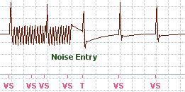 Inhibit or SVT Diagnosis inhibited Unbinned interval (dash) The Patient Activated or Symptom marker is only shown in stored EGMs and not on the real-time display. Activity and Noise Markers Table 2.