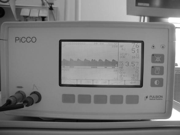 a. Metode minim invazive prin analiza conturului undei de puls (PiCCO, LiDCO, Vigileo) Analiza conturului undei de puls determină debitul cardiac prin folosirea unui algoritm care are la baza ipoteza