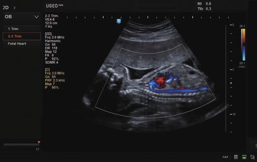 Fetal abdomen ascites