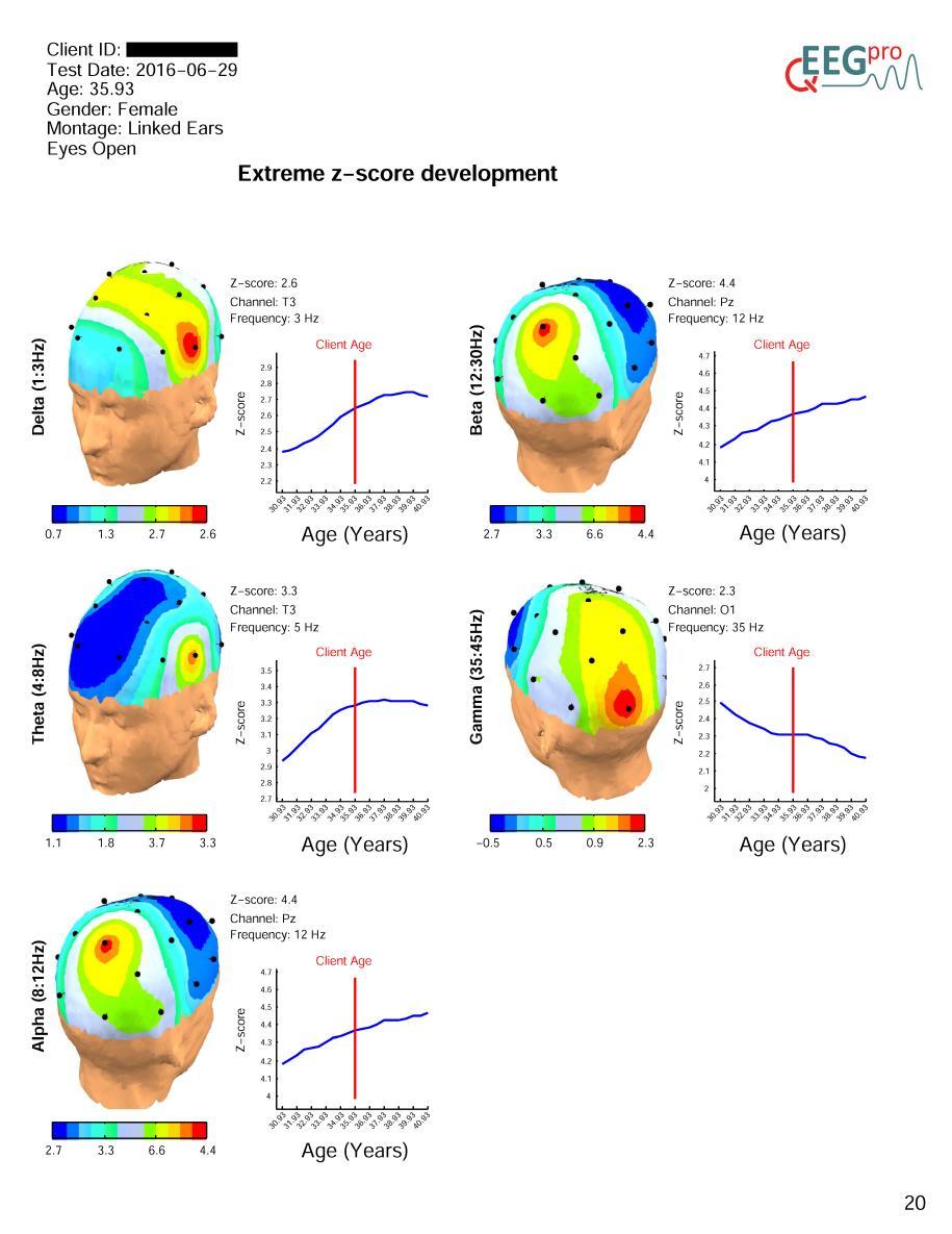16. Extreme Z-score Development Section 13 of the qeeg-pro report contains the results of the extreme z-score development analysis.