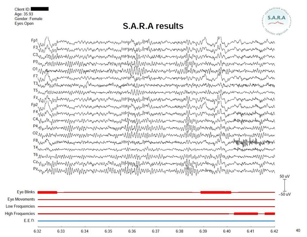 Figure 1. Example of one EEG segment in a SARA report.