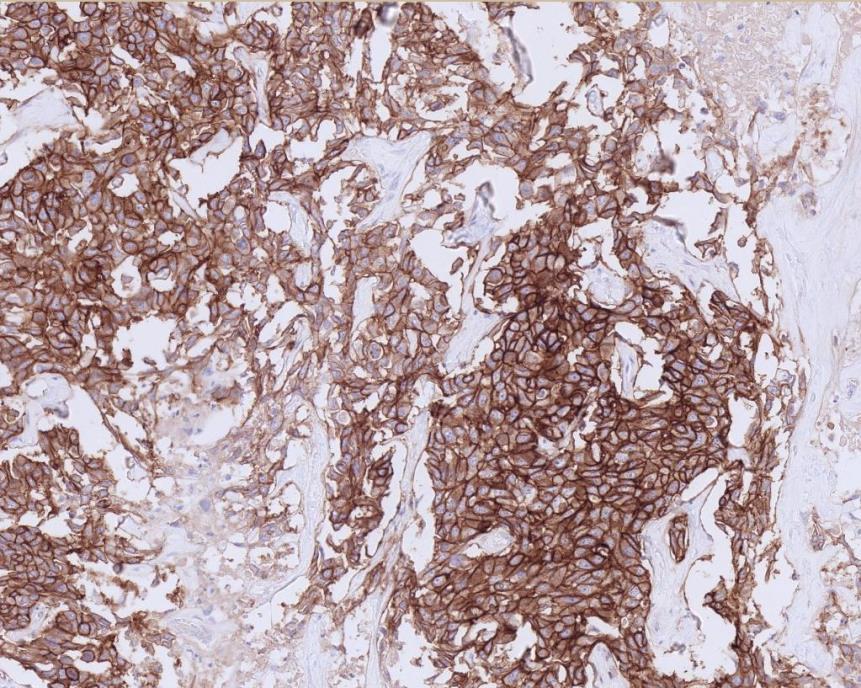 Difficulties Image Analysis Good for some immunohistochemical stains such as HER2 and ER Interpretation less subjective and with improved