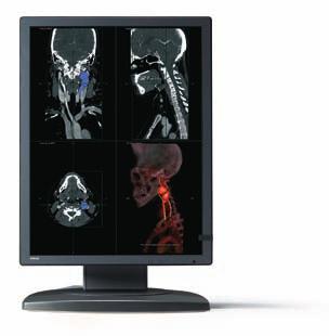 CORONIS A family of diagnostic precision CORONIS 2MP CORONIS 2MP is a cost-effective grayscale display system with a resolution of 1600x1200.